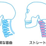 ストレートネック図